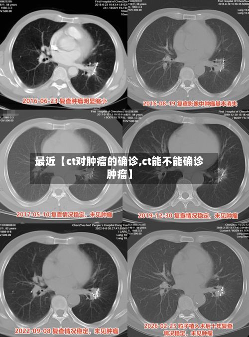 最近【ct对肿瘤的确诊,ct能不能确诊肿瘤】-第3张图片