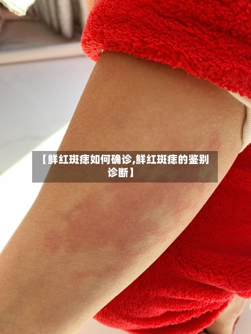 【鲜红斑痣如何确诊,鲜红斑痣的鉴别诊断】-第1张图片