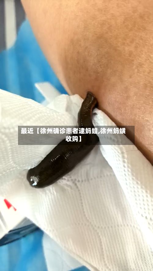 最近【徐州确诊患者逮蚂蝗,徐州蚂蟥收购】-第3张图片