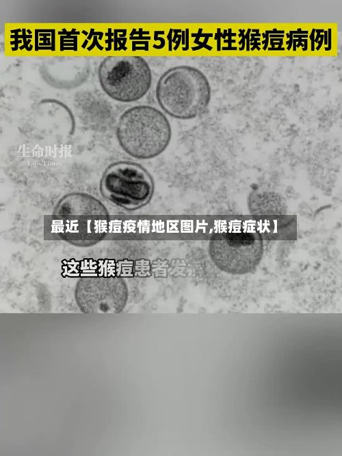 最近【猴痘疫情地区图片,猴痘症状】-第1张图片