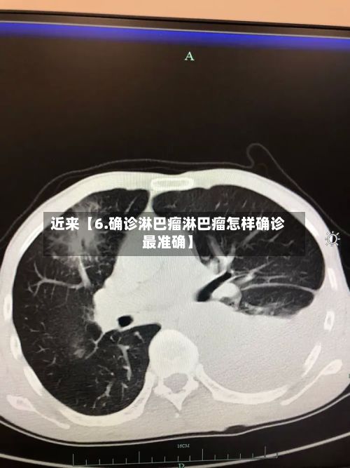 近来【6.确诊淋巴瘤淋巴瘤怎样确诊最准确】