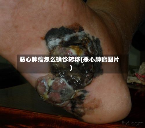 恶心肿瘤怎么确诊转移(恶心肿瘤图片)-第1张图片
