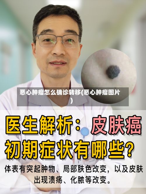 恶心肿瘤怎么确诊转移(恶心肿瘤图片)-第2张图片